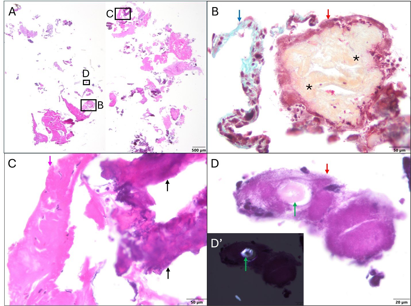 Representative histological images of debris captured by the SENTINEL device during VIV-TAVR with BVF