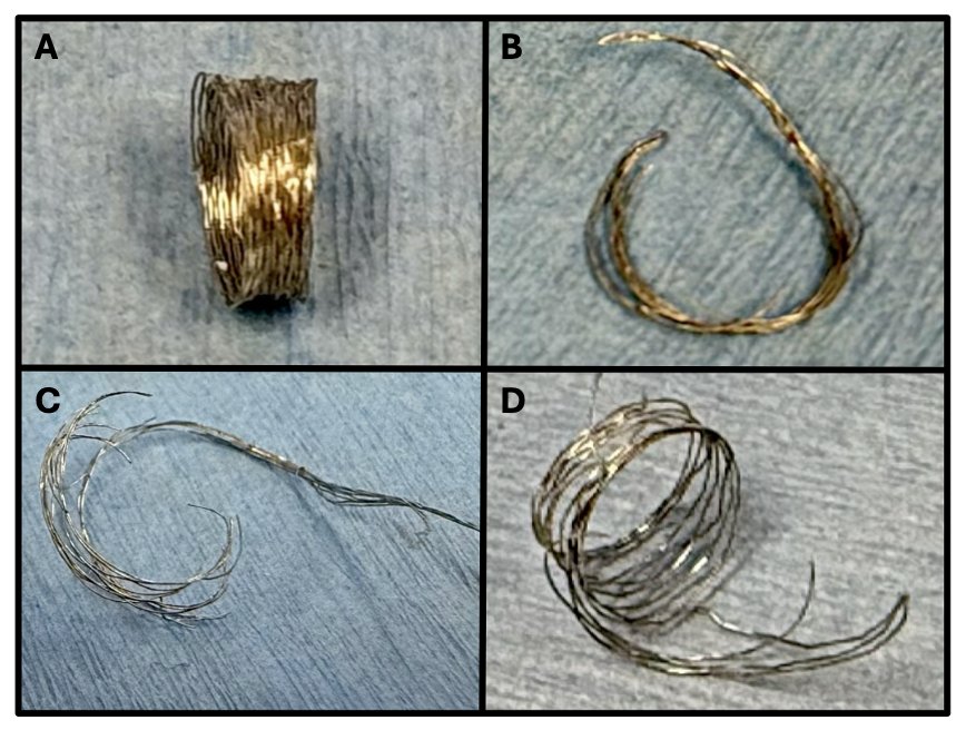 Complex Onyx Stent Fracture Patterns